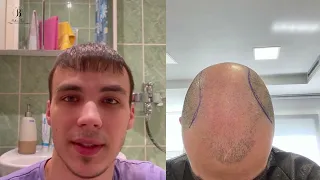 Detailed hair transplant result review from all angles - large baldness and 1 FUE session