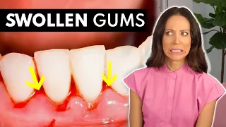 What SWOLLEN GUMS Are Telling You & What To Do About It!