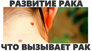 РАЗВИТИЕ РАКА | Продукты которые вызывают рак