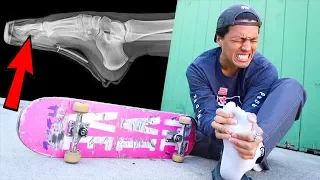 MY MOST SERIOUS SKATE INJURY YET!