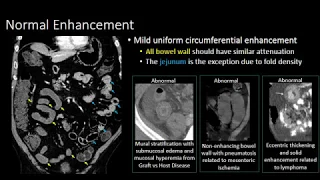 The Normal Small Bowel