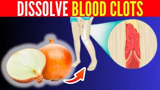 Top 8 Foods That DISSOLVE Blood Clots Naturally!