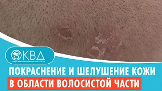 😕 Покраснение и шелушение кожи в области волосистой части головы. Клинический случай №606