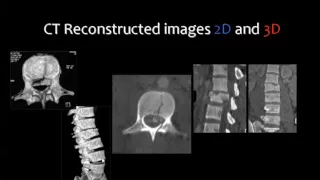 Imaging of Spinal trauma   DRE 6   Dr Mamdouh Mahfouz