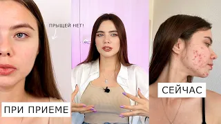 МНЕ НЕ ПОМОГ РОАККУТАН 😭