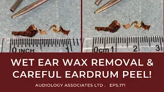 WET EAR WAX REMOVAL AND CAREFUL EARDRUM PEEL! - EP 171