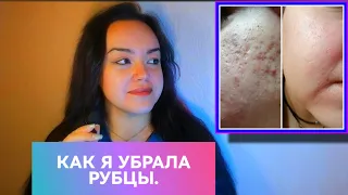 УБРАЛА РУБЦЫ!✅Без лазерных шлифовок❌