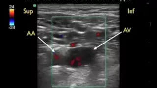 How To: Axillary Vein Cannulation - Sonosite Ultrasound.mp4