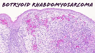 Botryoid embryonal rhabdomyosarcoma: Basic soft tissue pathology ("sarcoma botryoides" usmle)