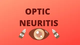 Optic Neuritis| Definition,Types,Causes,Symptoms,Signs,Investigation,Treatment | Ophthalmology