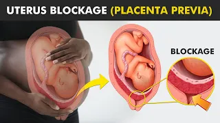 Placenta Previa Revealed: A Hidden Danger (What Every Parent Needs to Know)