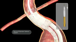 INCRAFT™ AAA Stent Graft System Aortic Extension Deployment Guide