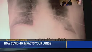How COVID-19 Impacts Your Lungs