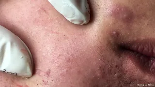 Inflammatory acne removal | Film by my self | Acne treatment Hương Đà Nẵng