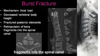 cervical spine -trauma Radiology @RadiologyChannel @educationalradiologychanne9079