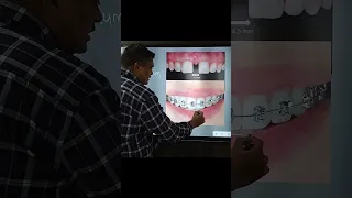 दाँतो के बीच के गैप को कैसे ठीक करें|| #toothcap #composite #veneers #shorts