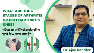 What are the 4 stages of arthritis or osteoarthritis knee? Dr Randive's Super Speciality Knee Centre