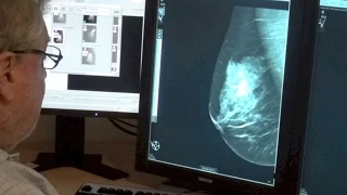 Do 3-D mammograms improve breast cancer screening?