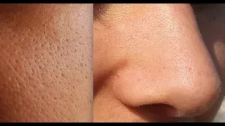 How I Shrank My Pores (How To Shrink Pores And Best Products To Remove Blackheads On Nose)