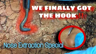 FINALLY GOT IT🪝| Ingrown Hair Removal & Extractions Part 12 w/ Nose Extraction | Beard & Neck Area