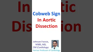 Cobweb sign in aortic dissection