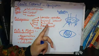 SENILE CATARACT very IMPORTANT topic ade simple part 1