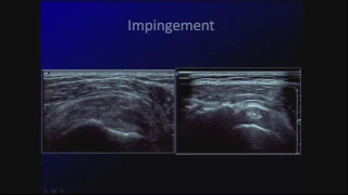 Sonography of Common Shoulder and Elbow Pathology