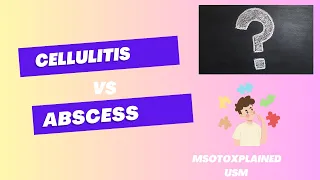 Cellulitis vs Abscess