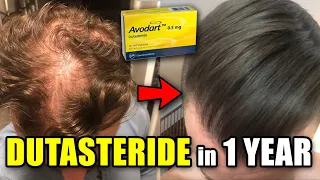 CRAZY Dutasteride Hair Loss REVERSAL In Only 1 Year