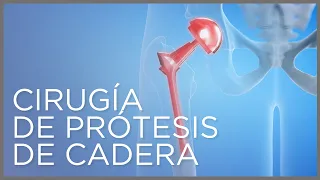 Cirugía de prótesis de cadera: recuperación y postoperatorio
