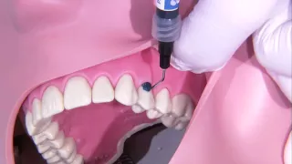 Odontología conservadora / Restauración del cuello del diente