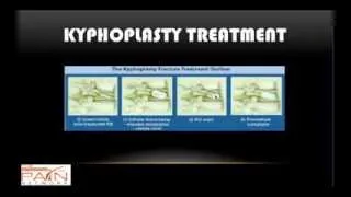 Info on Kyphoplasty for Vertebral Compression Fractures