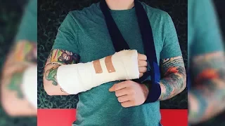 Ed Sheeran Breaks His Arm In Bicycle Accident