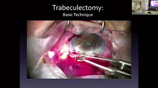 Lecture: Glaucoma Filtration Surgery