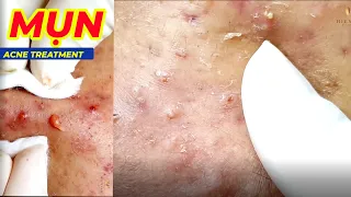 Điều trị mụn hiệu quả tại TPHCM | HV Clinic | Hiền Vân Spa | Acne Treatment Đỗ Thu Hiền | 714