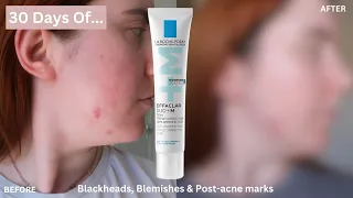 30 DAYS OF La Roche-Posay Effaclar Duo for Blemishes, Blackheads & Post-Acne Marks |One Month Review