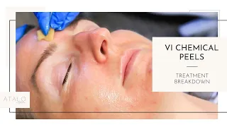 VI Peel Treatment  I  Chemical Peels