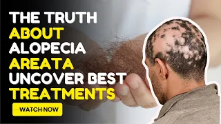 The Truth About Alopecia Areata (Uncover Best Treatments)