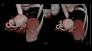 CT Evaluation of the Spleen: Challenges in Diagnosis Part 3