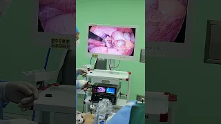 Laparoscopic Appendectomy