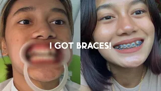 I GOT BRACES! (how much?, masakit ba?) | PH