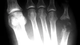 What is OSTEOMYELITIS? Signs and Symptoms, Causes, Treatment, Risk Factors of Bone Infection