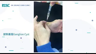 Nonsurgical Treatment for Ganglion Cysts(Turn on subtitles)
