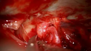 Clip Reconstruction of a Ruptured Aneurysm from p1 PICA with Extradural Origin