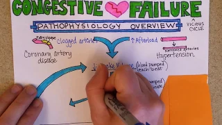 Congestive Heart Failure: Pathophysiology