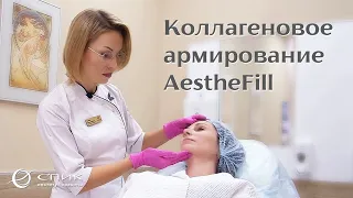 Коллагеновое армирование AestheFill в Институте красоты СПИК