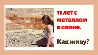 Сколиоз. Как я живу 11 лет с металлом в спине после операции