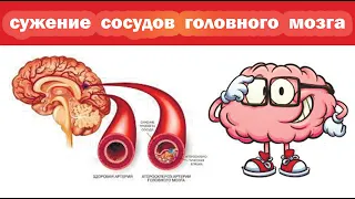 Рецепт от сужения сосудов головного мозга. Копеечное средство для лечения сосудов