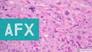 Atypical fibroxanthoma (AFX) vs mimics (spindle cell melanoma, squamous cell carcinoma, etc)