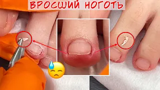 Вросший ноготь на маленьком пальце ноги 🦶 Что делать?